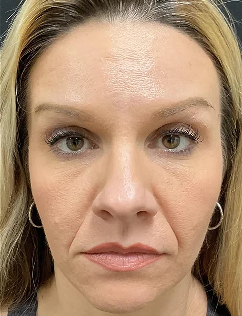 Actual Botox Patient After Treatment