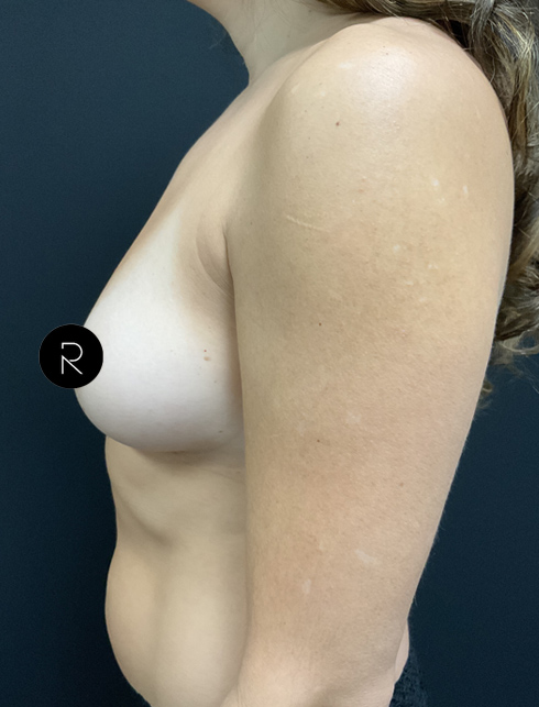 Breast Augmentation