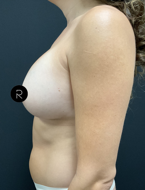 Breast Augmentation