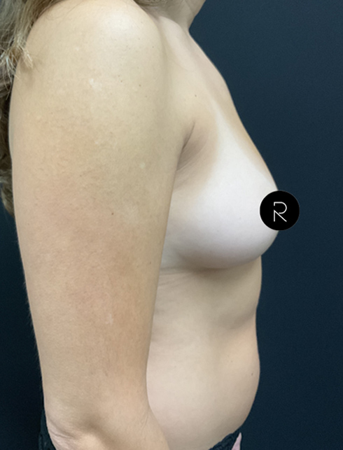 Breast Augmentation