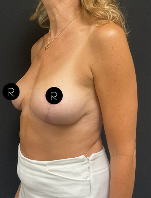 Breast Augmentation w/ Fat Grafting