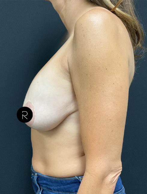 Breast Augmentation w/ Fat Grafting