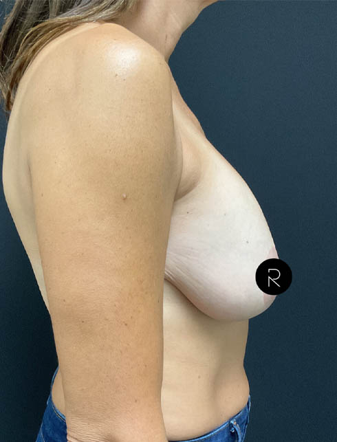 Breast Implant Removal