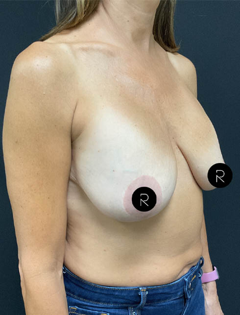 Breast Lift