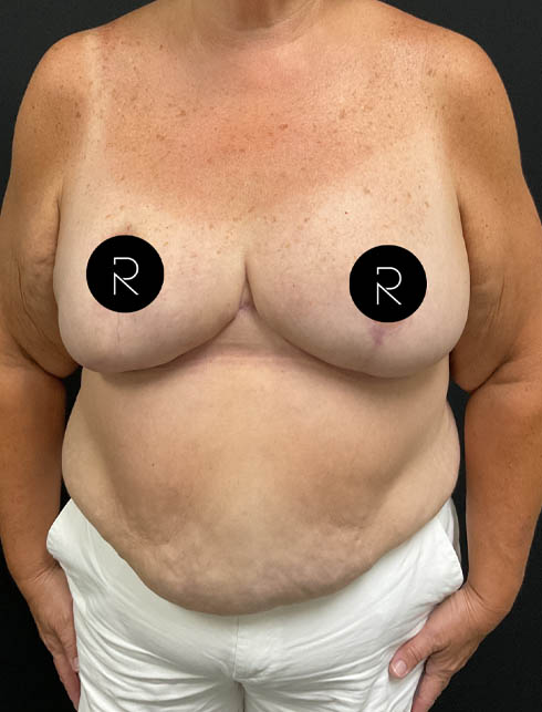 Breast Lift