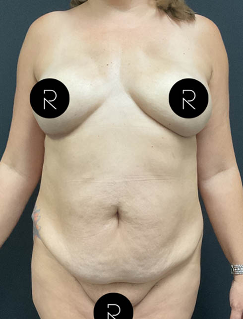 Abdominoplasty