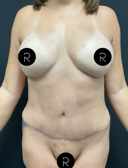 Abdominoplasty