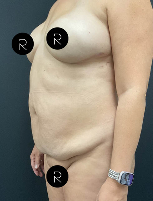 Abdominoplasty