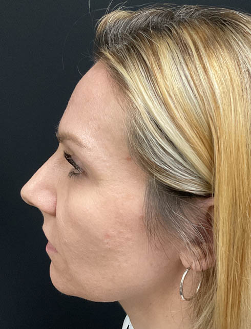 Dermal Filler