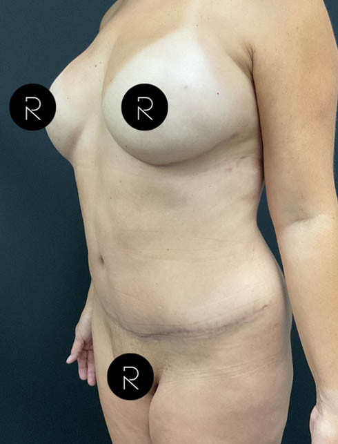 Abdominoplasty