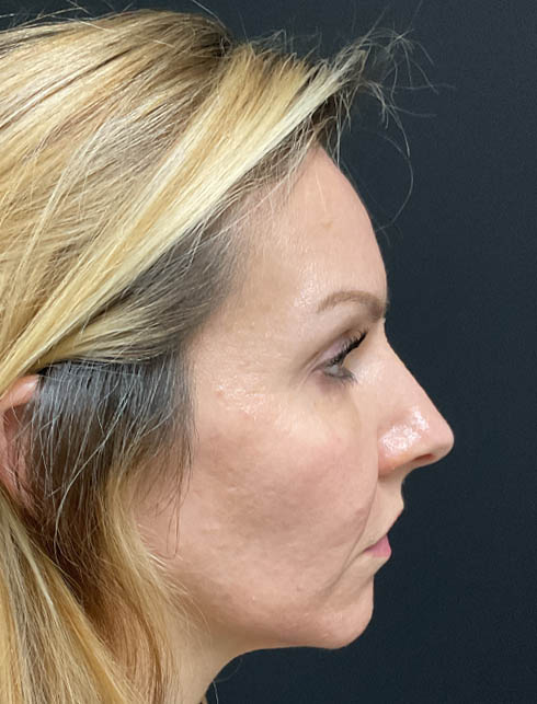 Dermal Filler