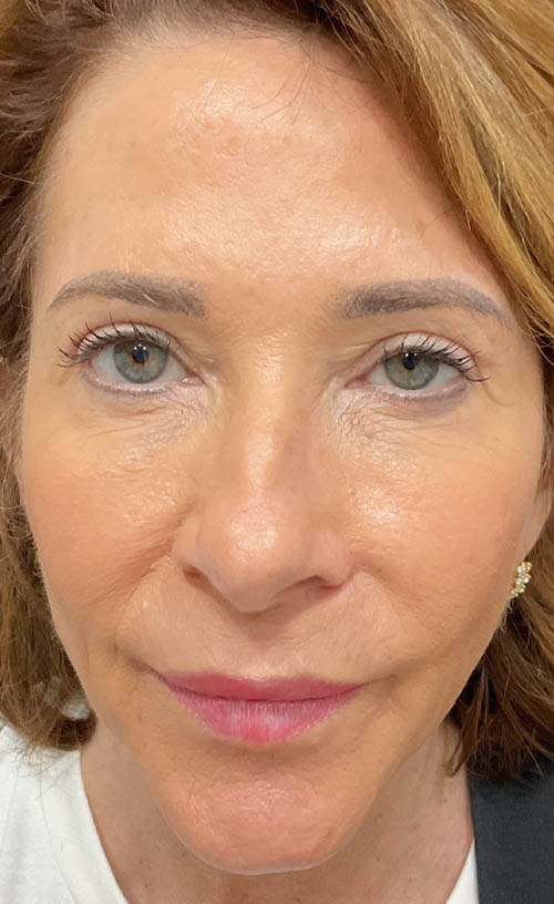 Blepharoplasty