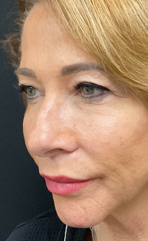 Blepharoplasty