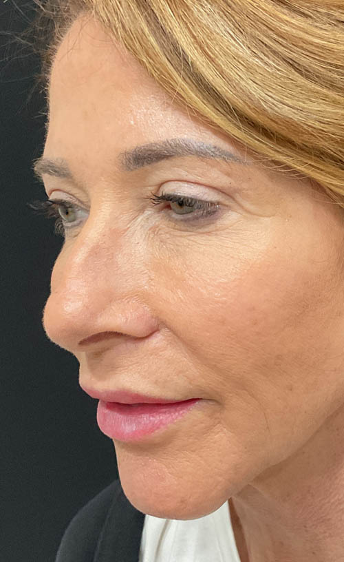 Blepharoplasty