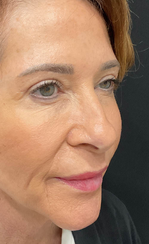 Blepharoplasty