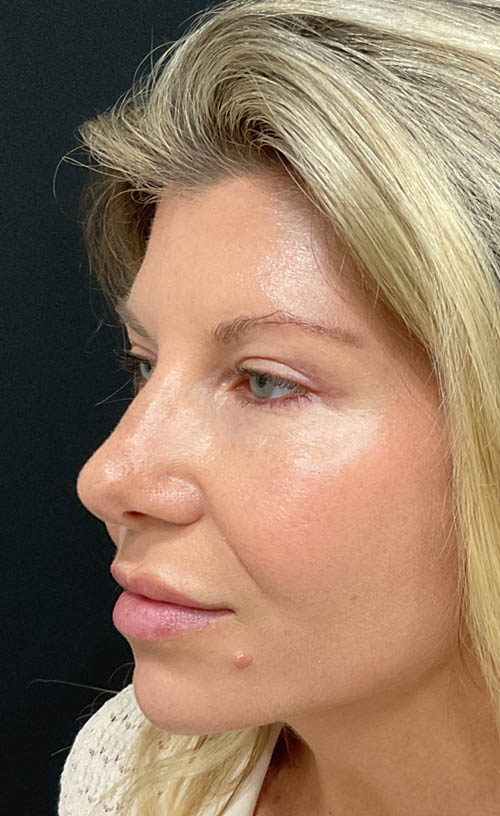 Blepharoplasty