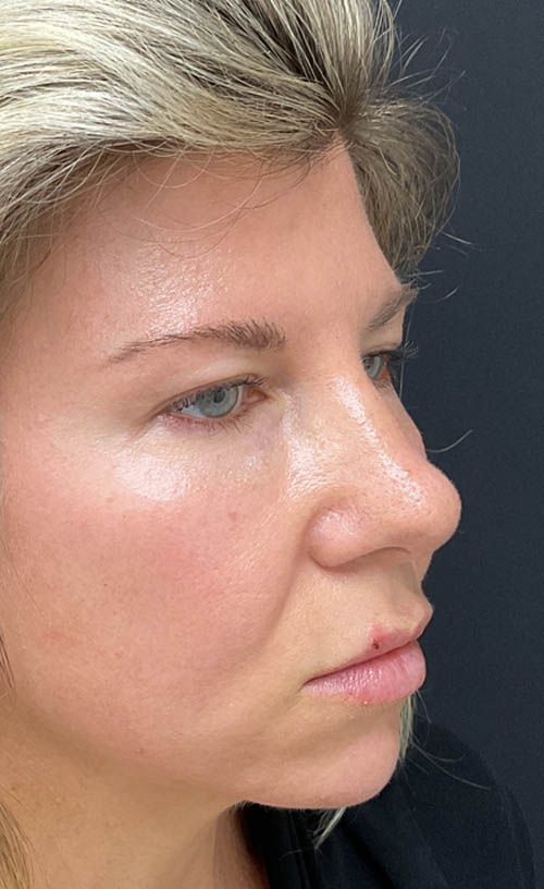 Blepharoplasty
