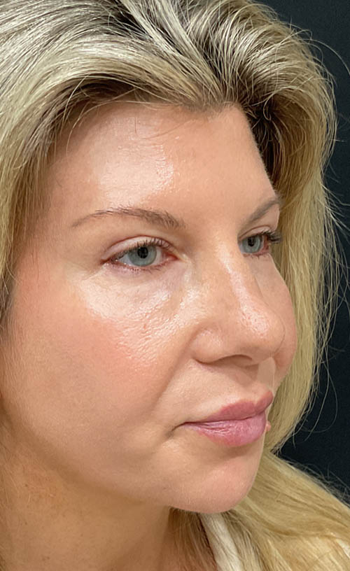 Blepharoplasty