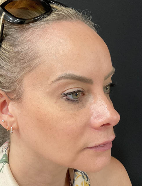 Dermal Filler