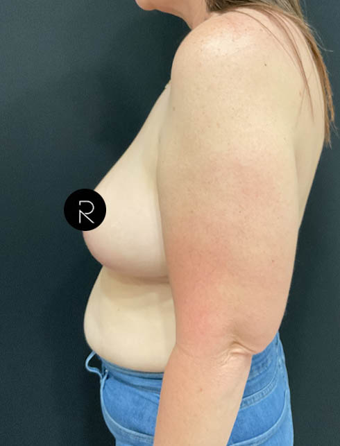 Breast Lift/Reduction