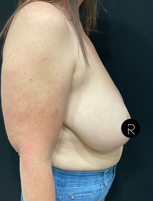 Breast Lift/Reduction