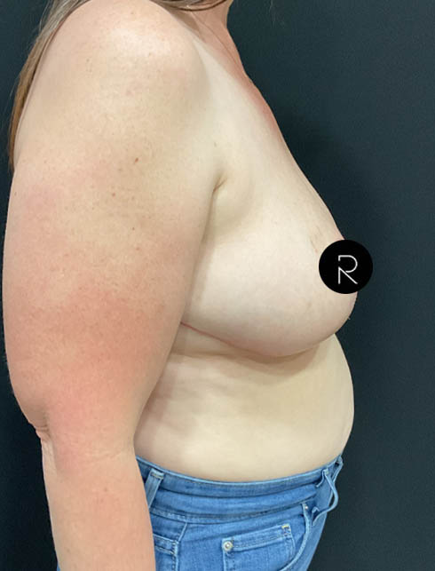 Breast Lift/Reduction