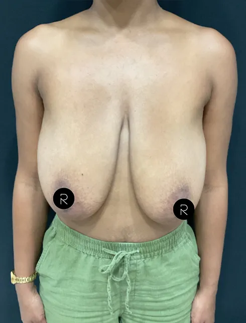 Breast Lift/Reduction