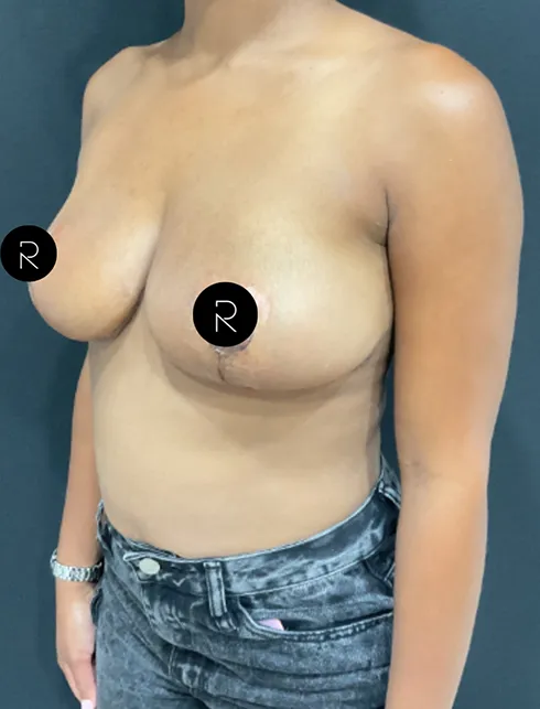 Breast Lift/Reduction