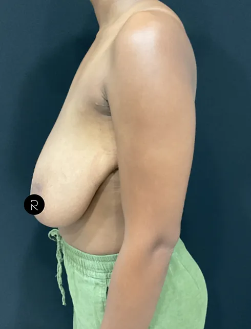 Breast Lift/Reduction