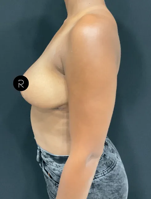 Breast Lift/Reduction