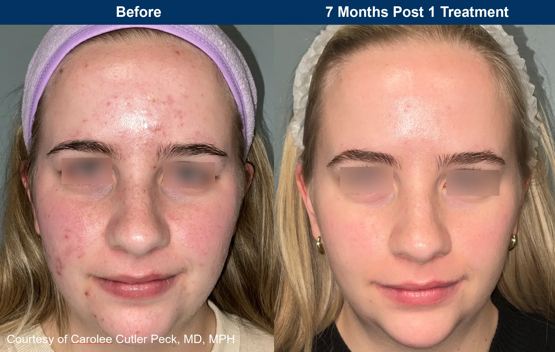 Actual Botox Patient Before Treatment