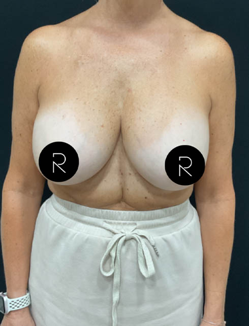 Breast Implant Removal