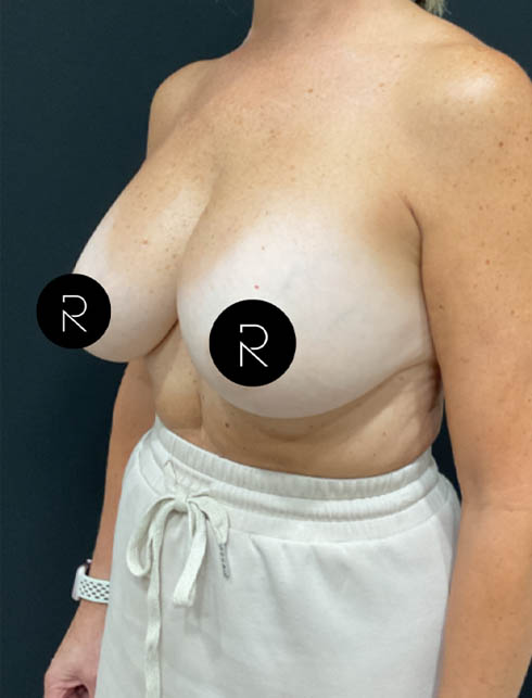 Breast Implant Removal