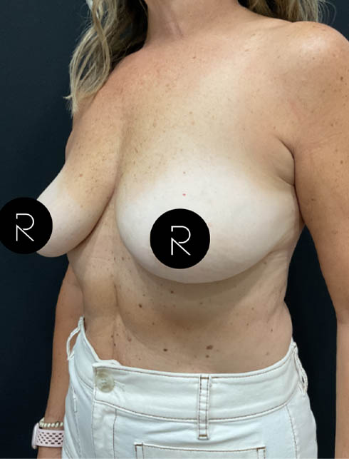 Breast Implant Removal