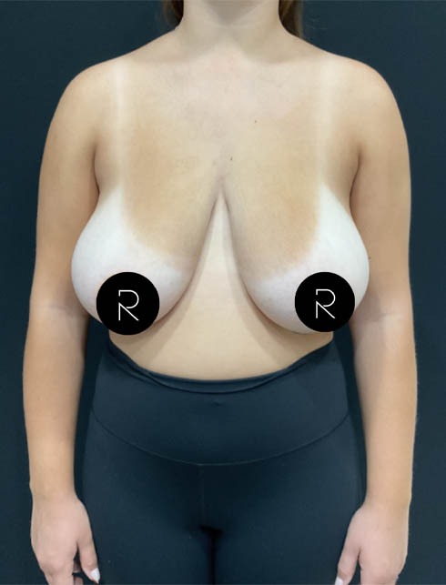 Breast Lift/Reduction