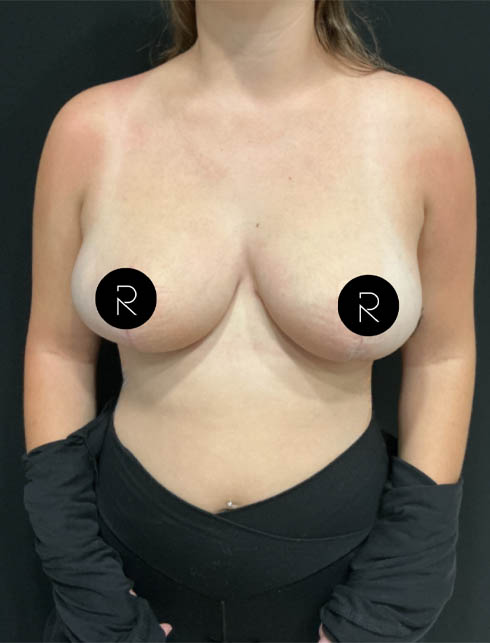 Breast Lift/Reduction