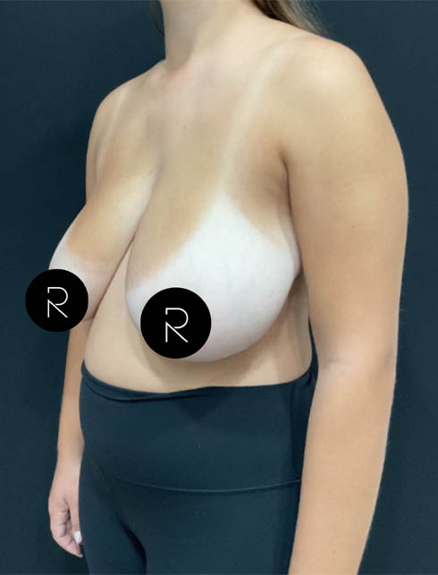 Breast Lift/Reduction