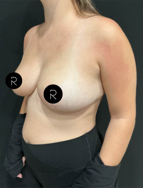 Breast Lift/Reduction