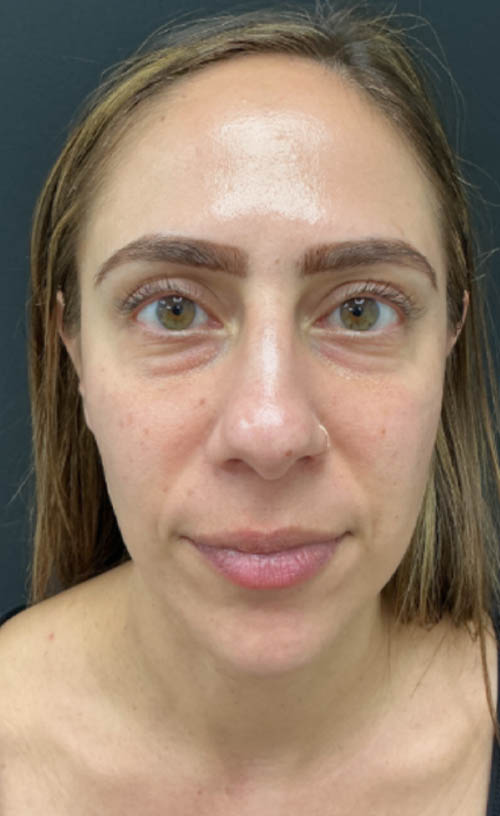 Lower Blepharoplasty