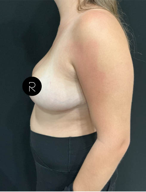 Breast Lift/Reduction