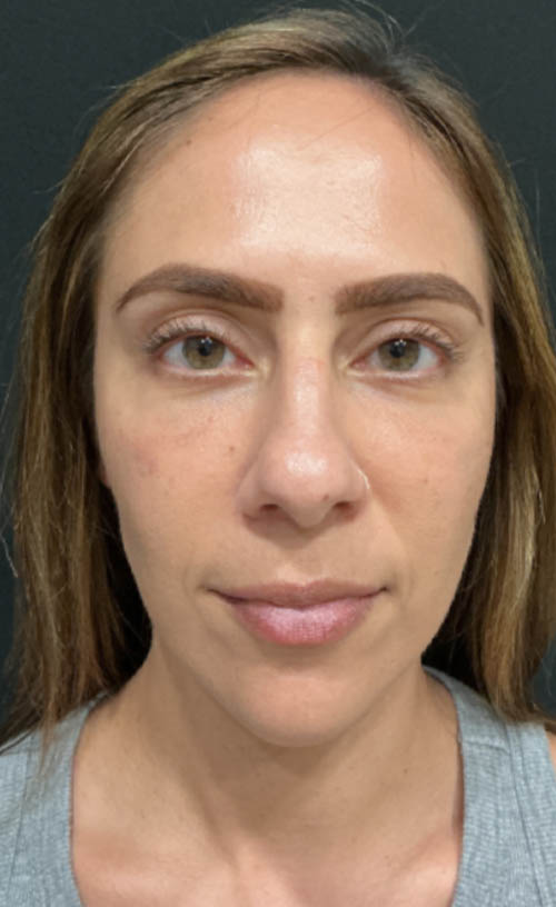 Lower Blepharoplasty