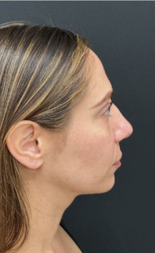 Lower Blepharoplasty