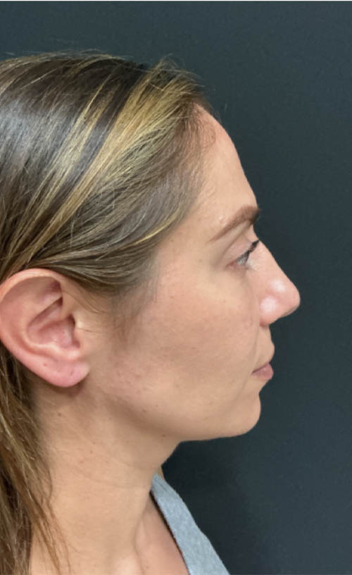 Lower Blepharoplasty