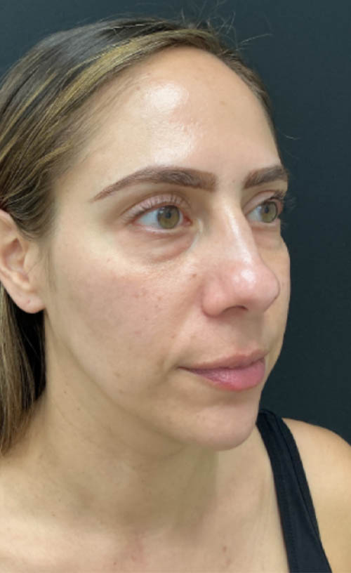 Lower Blepharoplasty