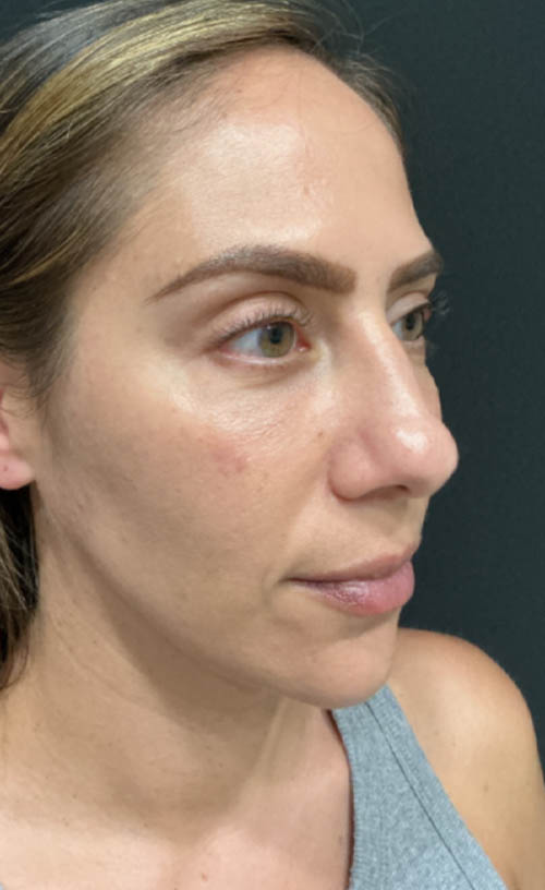Lower Blepharoplasty