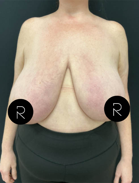 Breast Lift/Reduction