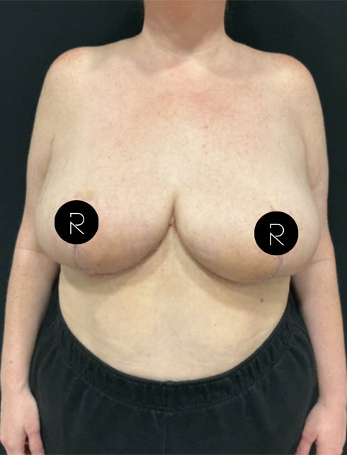 Breast Lift/Reduction