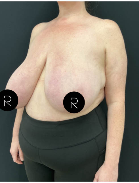 Breast Lift/Reduction