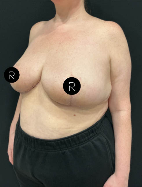 Breast Lift/Reduction