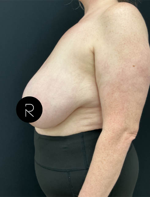 Breast Lift/Reduction